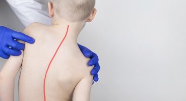 Skolyoz Tedavisinde Doğru Sanılan 7 Yanlışa Dikkat!