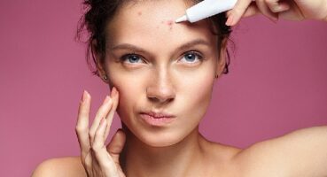 Akne tedavisinde yapılan 10 önemli hata !