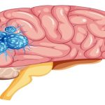 Beyin Tümörü Ameliyatı: Süreç, Riskler ve İyileşme Süreci