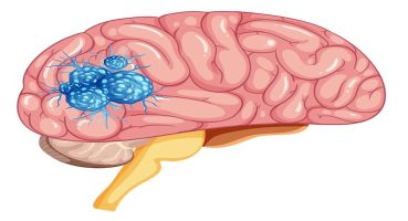 Beyin Tümörü Ameliyatı: Süreç, Riskler ve İyileşme Süreci