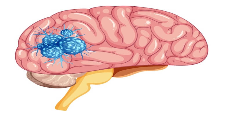 Beyin Tümörü Ameliyatı: Süreç, Riskler ve İyileşme Süreci